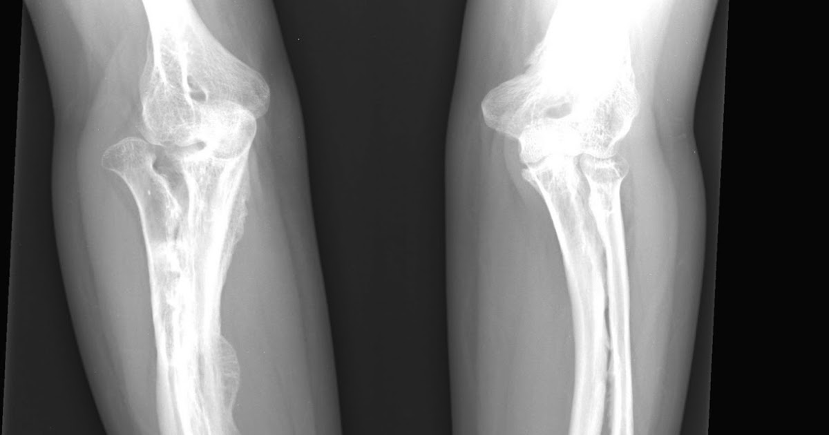 osteogenesis imperfecta research paper osteogenesis imperfecta research paper