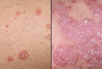 http://herbalalamiteripanglaut.blogspot.com/2015/07/pengobatan-alami-penyakit-kulit.html