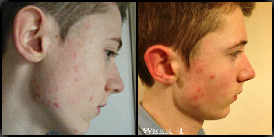 cherrysue doin the do proactiv anti blemish 4 piece kit a four proactive before and after
