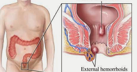 Pengobatan Herbal Untuk Penyakit Wasir ~ Blog Seputar Informasi Kesehatan