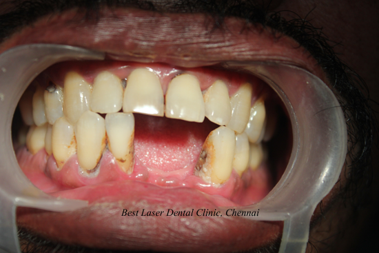 Lower Front Tooth Replacement using dental implants