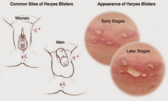 Does Everyone Have the Same Genital Herpes Symptom?