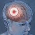 INFORMASI KESEHATAN KUSUS STROKE;