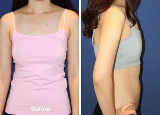 Image Result For Fat Transfer Before And Aftera Image Result For Fat Transfer Before And Aftera