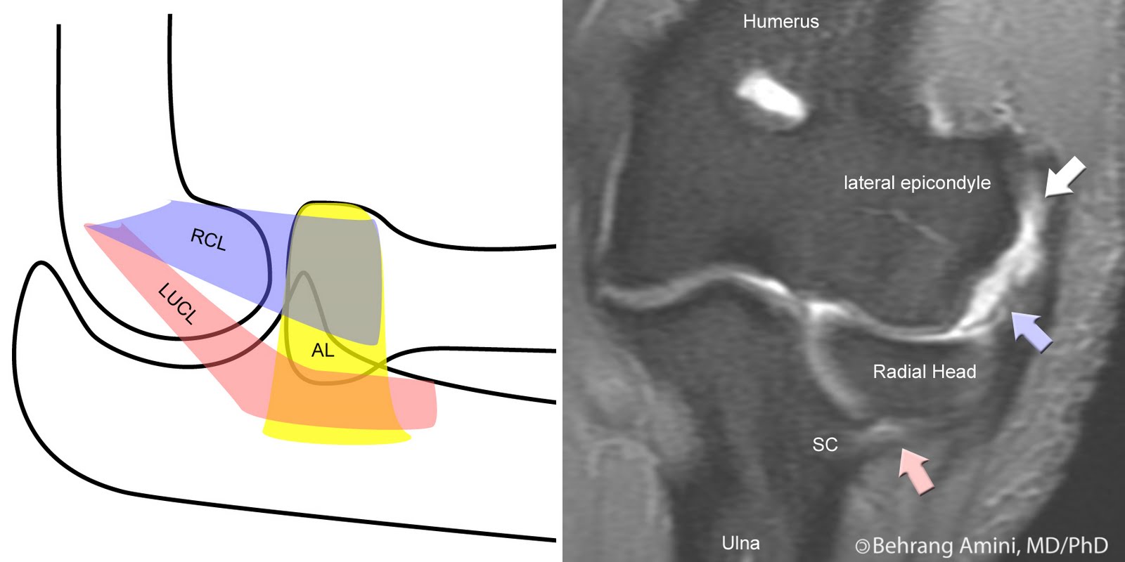 Extensor+Tendon+Repair+Protocol MRI Musculo-Skeletal Section: Radial collateral ligament pathology