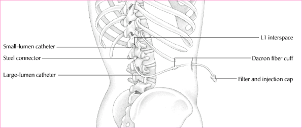 Lp Headache Blood Patch