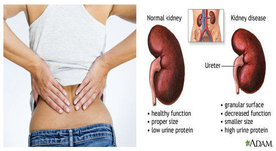 Early Symptoms of Kidney Disease and How to Keep Your Kidneys Healthy Symptoms of Kidney Disease