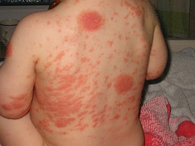 Wie die allergische Hautentzündung von atopitscheskogo komarowski zu unterscheiden