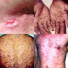 gambar sipilis sipilis akut, cara mengobati sipilis, sipilis laten, sipilis primer, pengobatan sipilis