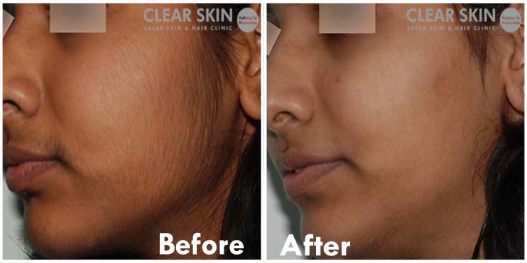 Natural Remedies Tips For Remove Facial Hair B G Fashion