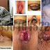 Ciri Wanita Menderita Sakit Wasir (Hemoroid) thumbnail