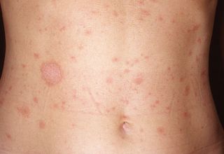 Maladie de Pityriasis rosé de Gibert Le Maladie de Pityriasis rosé de Gibert (qui tient son nom de Camille-Melchior Gibert) est une maladie dermatologique fréquente, caractérisée par dermatose érythémato-squameuse. Clinique Cette dermatose d'évolution cyclique en 6 semaines, de pronostic toujours bénin, d'apparition saisonnière (printemps-automne), chez des jeunes (entre 15 et 30 ans) le plus