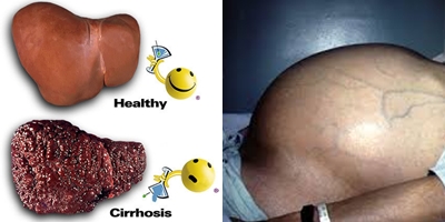 cara mengobati penyakit liver kronis alami