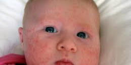 Tips on How to Do Away With Child Acne
