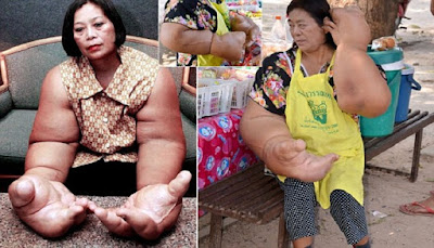 Sakit Langka, Wanita Ini Punya Tangan Terbesar di Dunia Sakit Langka, Wanita Ini Punya Tangan Terbesar di Dunia