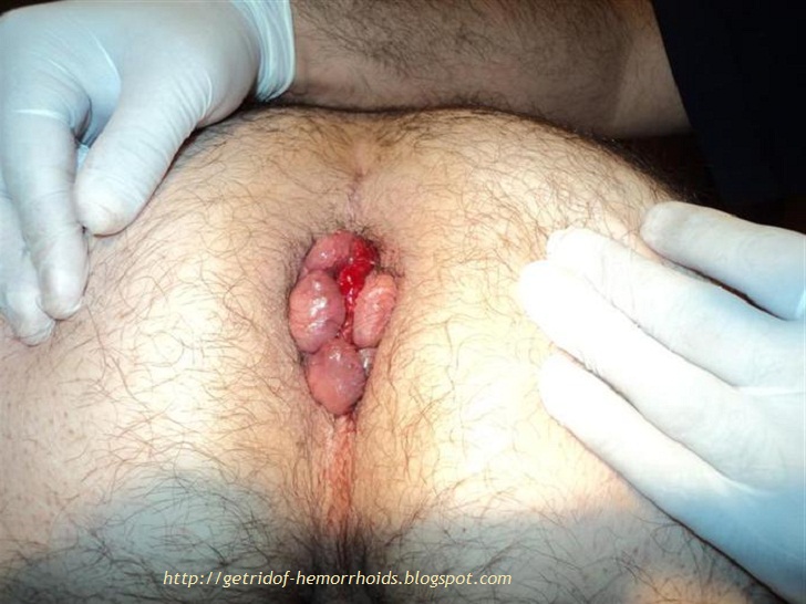 Get treating hemorrhoids and fissures