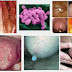 Obat Penyakit Seksual Gonore (GO) thumbnail