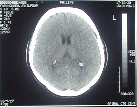 Ct+scan+brain+normal