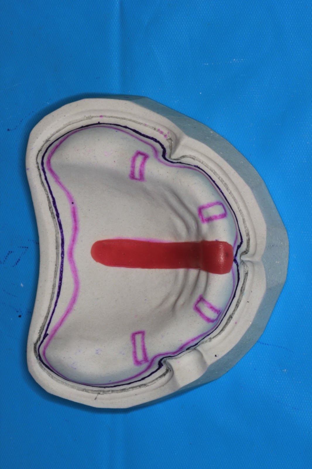 Step by step Guide for Understanding the Prosthodontics Spacer for