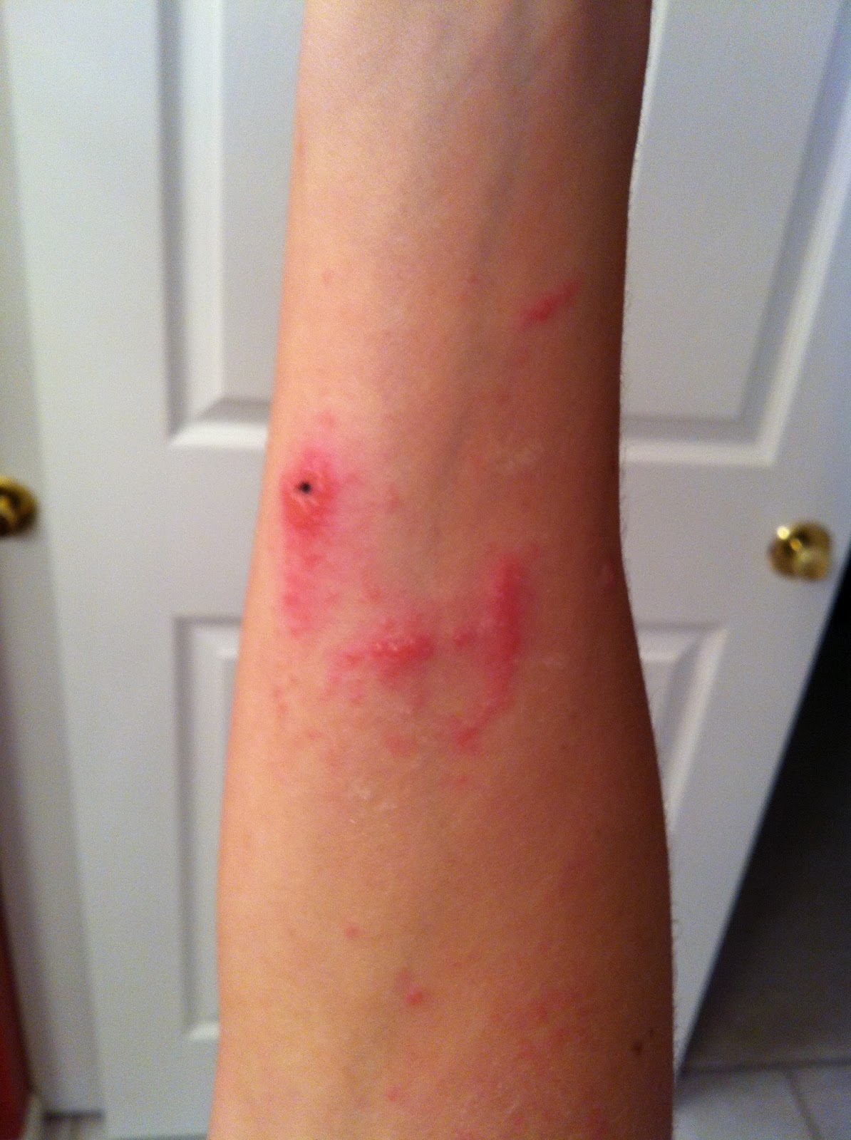 The End of the Poison Ivy Saga. With Pics! Charisa Darling