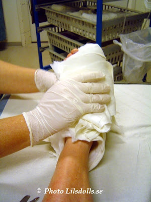 hallux valgus, halluxvalgus-operation, byte av gips