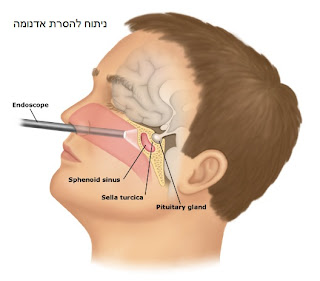 ניתוח להסרת אדנומה בהיפופיזה
