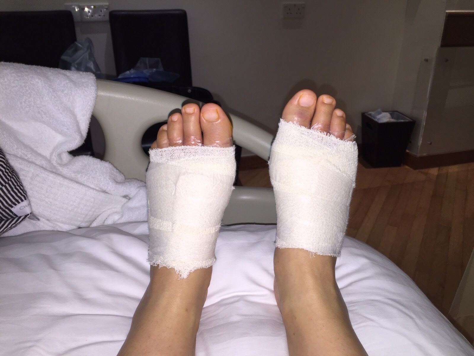 Alternative Bunion Surgery Day 2 After Surgery