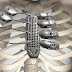 Implantan costillas de titanio impresas en 3D totalmene personalizadas