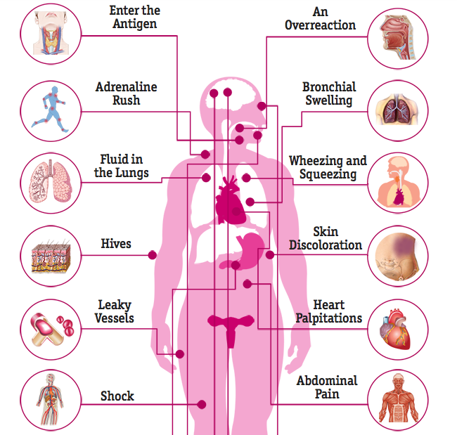 causes and symptoms of anaphylaxis biology essay Allergies and the immune system see related health to a life-threatening reaction know as anaphylaxis allergy symptoms can range from mild to a serious. causes and symptoms of anaphylaxis biology essay Allergies and the immune system see related health to a life-threatening reaction know as anaphylaxis allergy symptoms can range from mild to a serious.