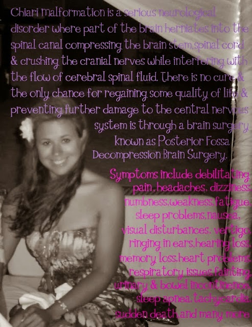 Chiari Malformation Symptoms Chiari Malformation, Brain Surgery, Symptoms, Thrive