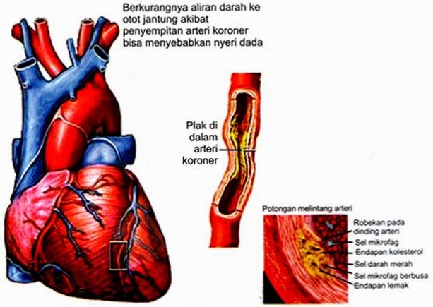 Penyakit Jantung Koroner penyakit jantung koroer