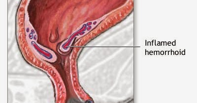 ENFERMERÍA - NURSING: HAEMORRHOIDS, FISTULAS AND PROCTITIS ENFERMERÍA - NURSING: HAEMORRHOIDS, FISTULAS AND PROCTITIS