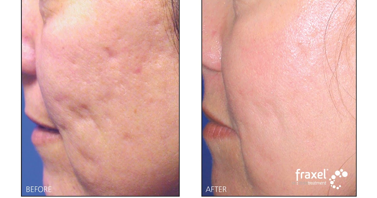 acne treatment sydney acne scar treatment with fraxel laser Sydney CBD, Wahroonga, Paddington