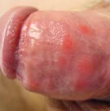 Obat Untuk Mencegah Sifilis Obat Untuk Mencegah Sifilis