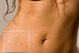 masalah selulit di perut, bagaimana hilangkan selulit kulit, masalah selulit, selulit merungsingkan wanita, rawatan masalah kelulit terbaik, collagen untuk selulit, bagaimana selulit berlaku, rawatan untuk jerawat
