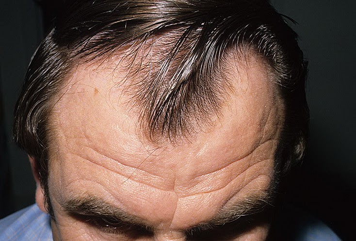 get rid of baldness androgenetic alopecia androgenic alopecia