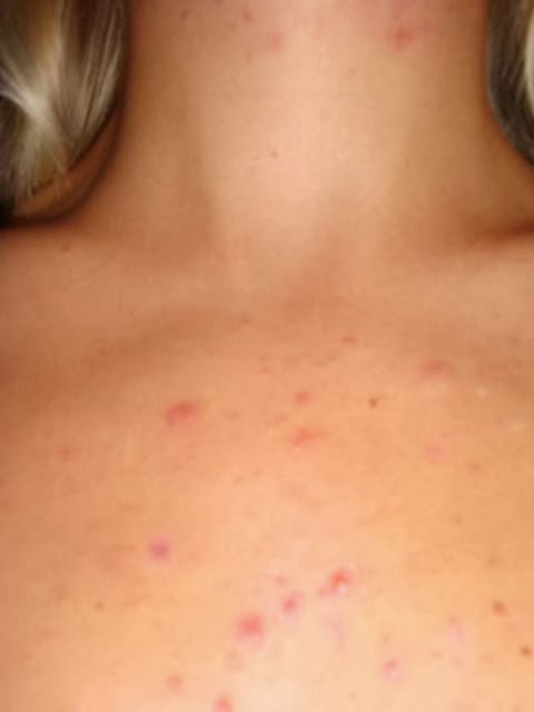 Erythromycin For Acne Scars
