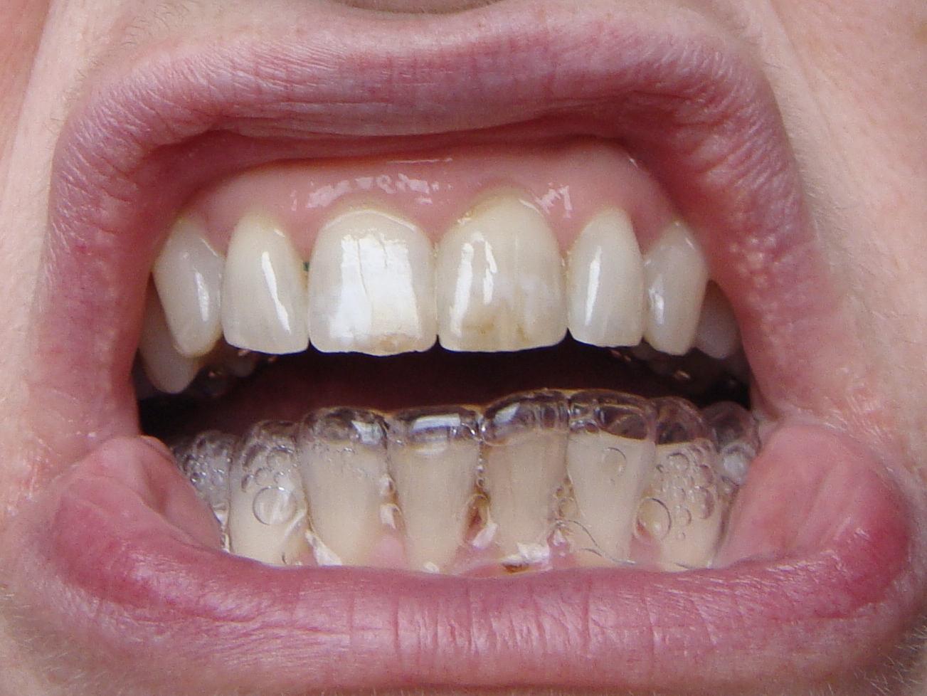 Braces at 56 Clear Retainer on Bottom Teeth Today! New wire for Incognito brace.