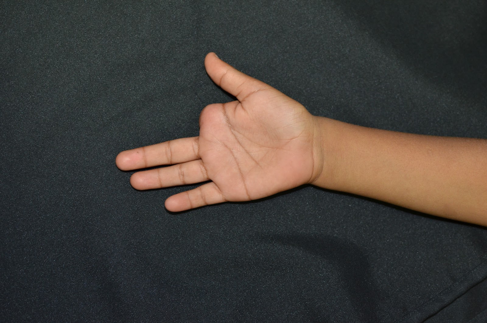 CRUSH INJURIES OF HAND AND UPPER LIMB INJURIES DOG BITE AVULSION