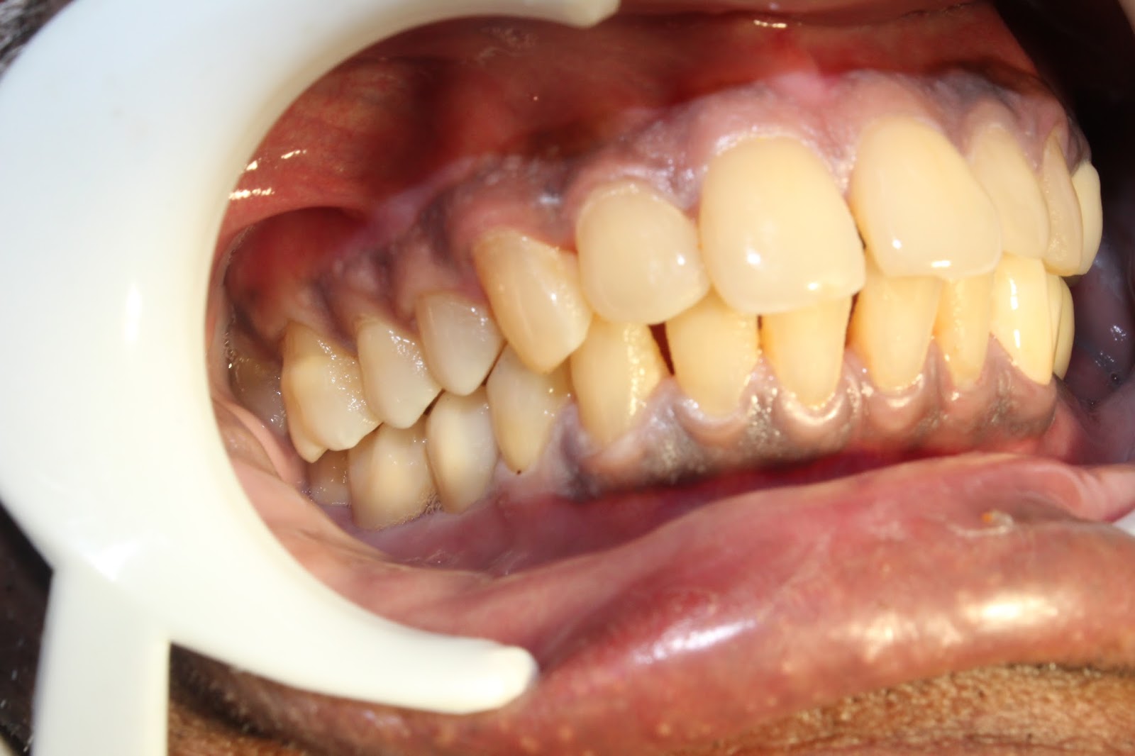 Zirconium bridges for teeth replacement with dental implants.