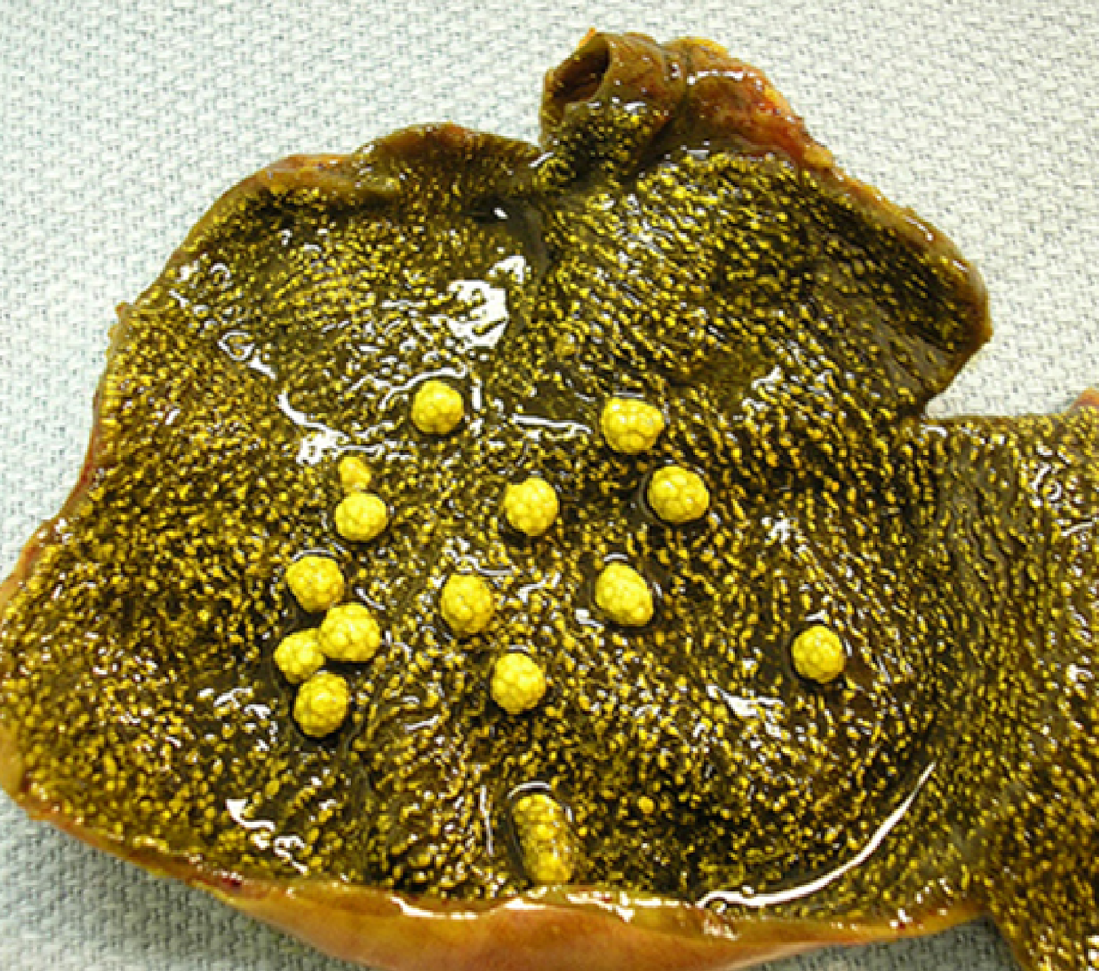 MBBS Medicine (Humanity First): Cholecystoses