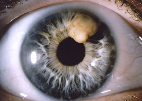 Iris Cyst In Dog Eye Iris Cyst In Dog Eye