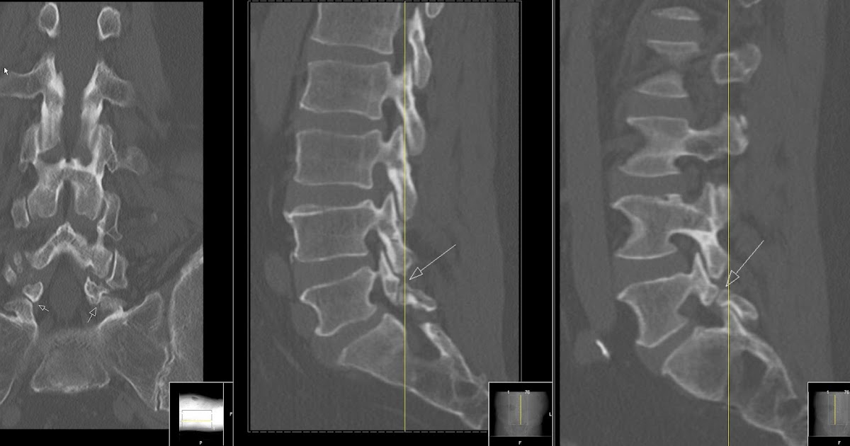 Spondylolisthesis definition picture