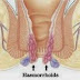 Harga Obat Ampuh Wasir Luar Selain Ambeven di Apotek thumbnail