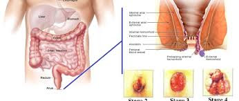 Obat Herbal Menyembuhkan Ambeyen Obat Herbal Menyembuhkan Ambeyen