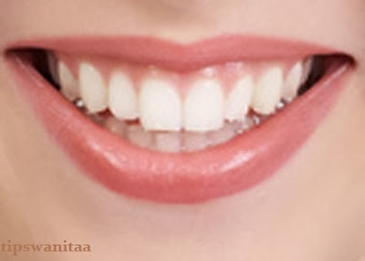 Cara Memutihkan Gigi Sederhana