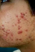 Consejos acné:  4 consejos para reducir el acné