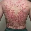 Contoh Askep ERITRODERMA http://asmanurs3.blogspot.co.id/