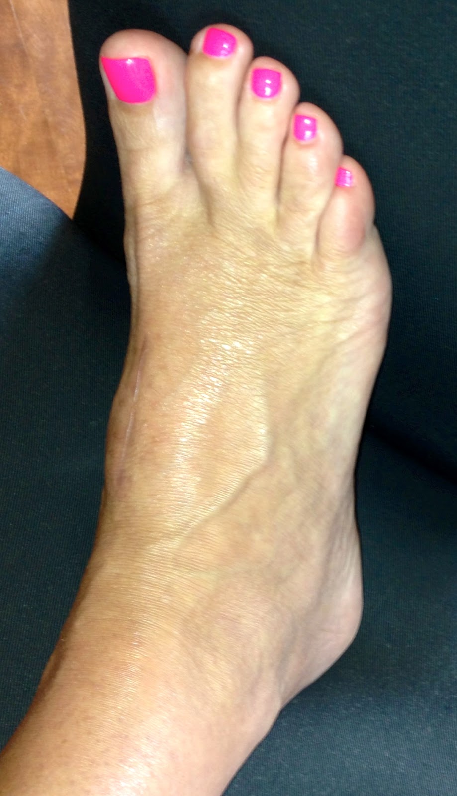 lisfranc boot lisfrancblog