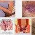 Obat Ambeien Cepat thumbnail